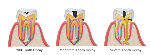 tooth-decay.jpg